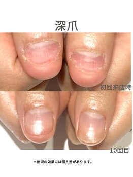 20代/深爪/3ヶ月後アフター