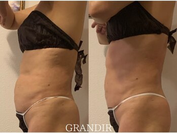 グランディール(GRANDIR)/【痩身】上半身コース5回目