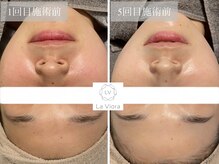 ラヴィオーラ 心斎橋店(La Viora)/ダイヤモンドハーブピーリング