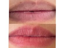 最新美容ローマピンク☆1度の施術で肌本来のピンク色に導きます