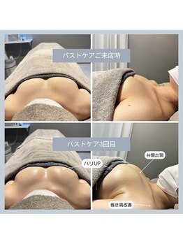 ヴァロ 熊本味噌天神(Valo)/バストケアビフォーアフター