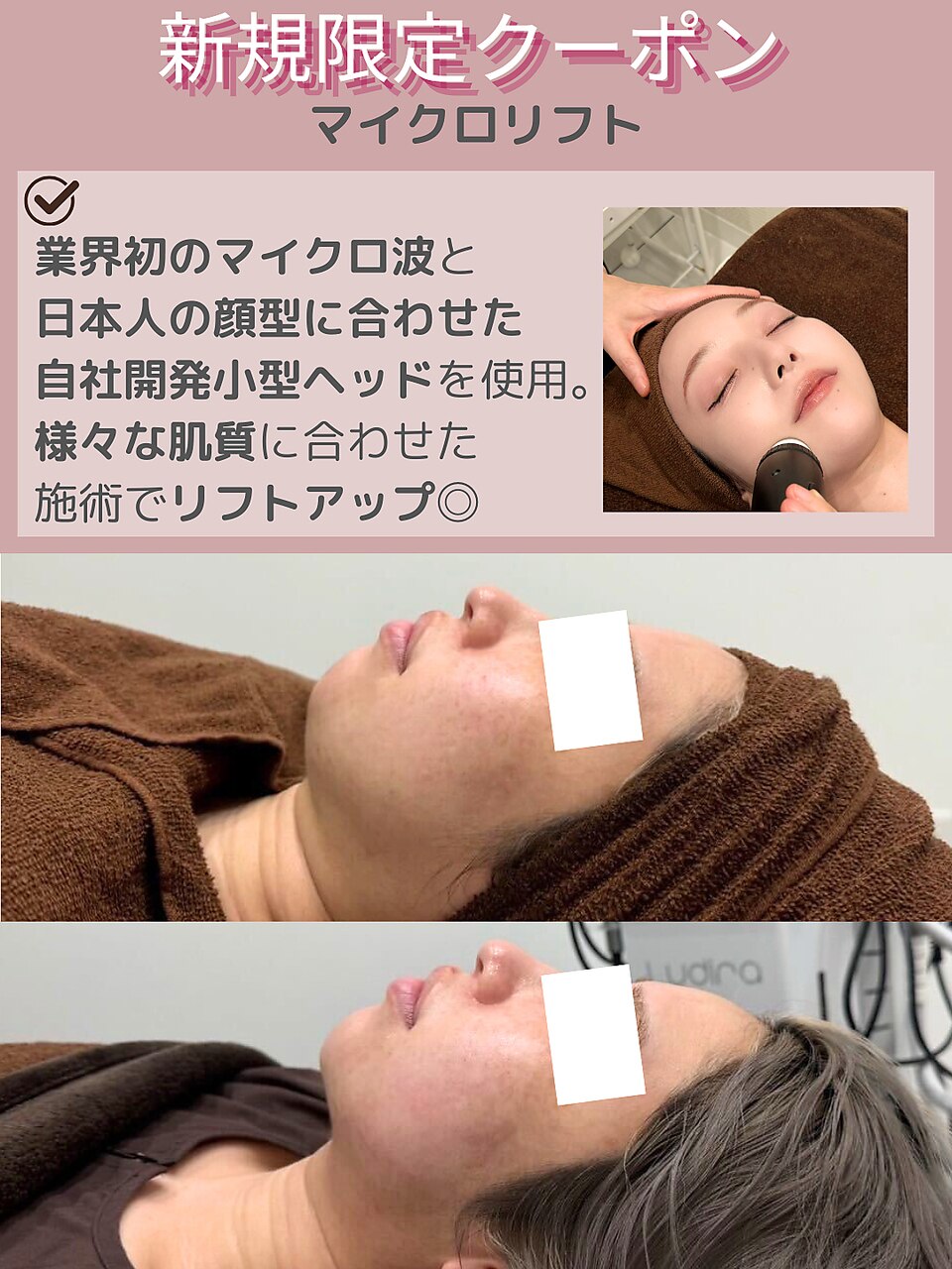 【小顔・脂肪撃退】小顔マイクロリフト(旧オンダリフト)￥13000