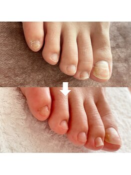 ビビィ(vivie)/埋もれた小指の爪も輪郭ハッキリ