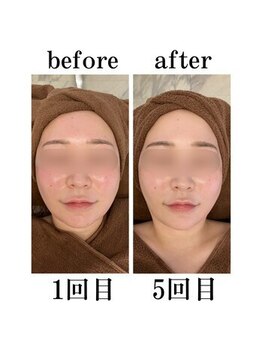 インディバケアプラチナム 横浜店/インディバ施術