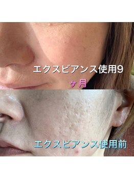 ロゼッティ(ROSETTY)/ニキビケア/水光ピール☆