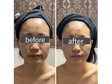 小顔アンドエイジングケア専門店 ビゼ(美sser)/美sser小顔コルギ