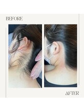 スプランドゥール(Splendeur)/うなじ　ワックス脱毛&光脱毛