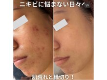 ファシル(Facile)の雰囲気（大人気ハーブピーリング）