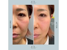 ホワイトラボ 姫路(White labo)/【施術例】エクソリフト/ExoLift