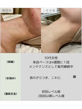 サロンエヌ 久留米店(Salon N)/ニキビ/跡