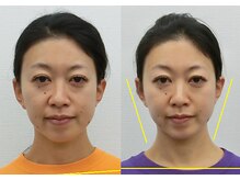 宮崎整体院/【小顔・顔の歪み矯正】