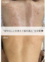 リアルナ(REALUNA)&nbsp;夏前！背中 ニキビケア