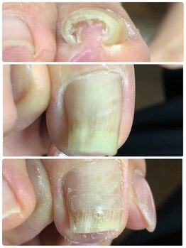 ネイル ウォッカ(NAiL VODKa)/【巻き爪ケア(B/S)】