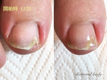 トラブルネイル