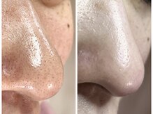 ミルフィオリ(Mille fiori)/初回ビフォーアフター