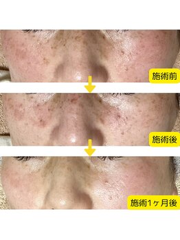 ネリネ(Nerine)/光フェイシャル経過写真