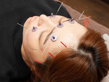 ふなと川接骨院 倉賀野院/眼精疲労の鍼施術【高崎　鍼灸】