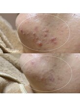 ソワ 吉塚店(soi)/繰り返す顎ニキビ！