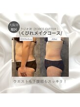 めいてる/脂肪撃退ラジオ波/お腹の脂肪