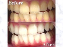 LBSホワイトニング 銀座店/セルフホワイトニングの症例写真