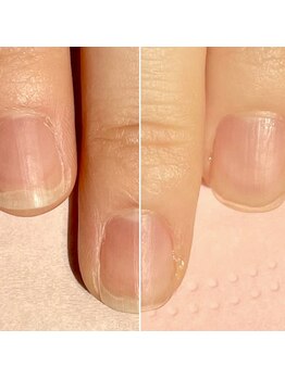 ココデネイル(cocode nail)/悩み:男爪、ささくれ(20代前半)