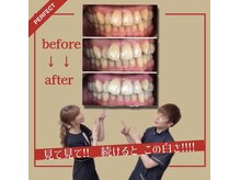 ホワイトニングプラス(Whitening+)/見て見て！！続けるとこの白さ