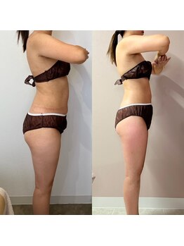 リリー(Lily)/セルゼロ全身3ヶ月