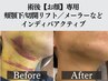 6月限定！《お顔専用術後ケア》ホホ/顎下/ジョール/メーラー吸引/45分7000円