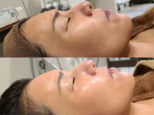 ブラン(BLANC)/【光フェイシャル】フォトRF