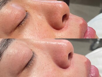 オパール 大阪梅田(op_l)/毛穴ケア/毛穴洗浄/毛穴黒ずみ