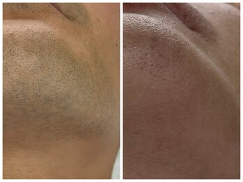 フェリス(FELIZ)/ヒゲ脱毛が楽になるヒゲ脱毛