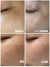 ユヌ(une)/光フォト　5回￥74000