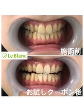 ルブラン 奈良店(Le Blanc)/1回1650円で照射可能！