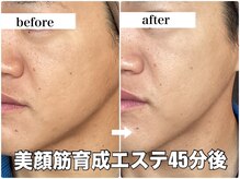 リエル(RIEL)/小顔矯正×美顔筋育成エステ