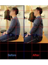 三ノ宮鍼灸院 接骨院/一回整体　ビフォーアフター