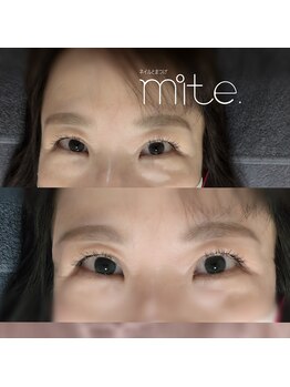 ミテ(mite.)/ふんわり眉毛ワックス脱毛