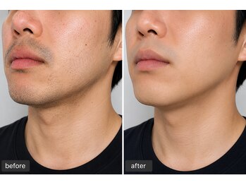 サロン スムース(Salon SMOOOTH)/ヒゲ脱毛のお客様のビフォアフ