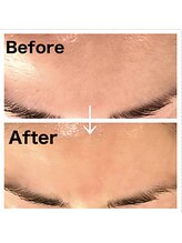 フィオーレ/【顔】美白＋美肌ワックス脱毛★