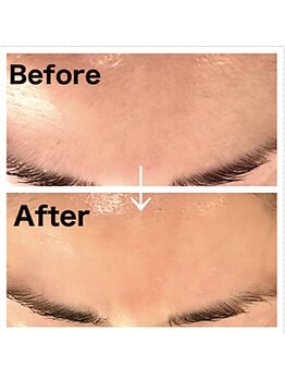 フィオーレ/【顔】美白+美肌ワックス脱毛★