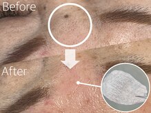 ジェジル バイ ジュリ(JAEJIL by Juri)/眉間のWAX脱毛