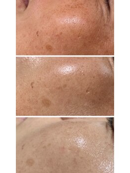 ムム(mumu)/くすみが取れ自身本来のお肌へ