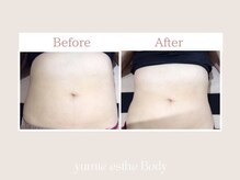 トータルビューティー ゆみえエステ(Total Beauty)/痩身/マグシェイプ　ウエスト