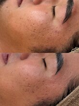 レイニゲン(H/Reinigen)/毛穴トラブル