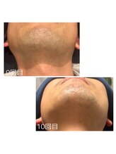 カナウ(KANAU)/10回でここまで綺麗になります！