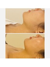 ルミア(LUMIA)/小顔造形ロイヤルコース２回目