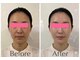 耳つぼアンドスリムケア イヤローブ(Earlobe)の写真/眠れるほど心地よい筋膜リリースで、1回でも実感のフェイスライン！疲れ目もスッキリ、ツヤ肌小顔へ！