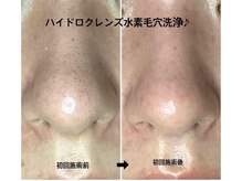 メディカルサロンドオフ 堺東店(medical salon de off)/水素毛穴洗浄♪