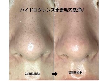 メディカルサロンドオフ 堺東店(medical salon de off)/水素毛穴洗浄♪