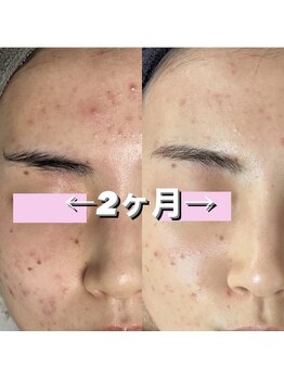 スピカ(Spica)/ニキビケアにはやっぱりこれ!