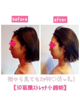 ビューティサロン キヨの部屋(beauty salon)/【３D筋膜ストレッチ小顔術】1回